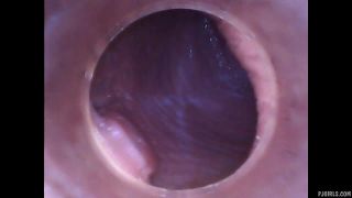 Silvie DeLuxe  RAW endoscopic video  2015-08-23l-4