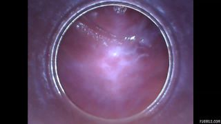 Silvie DeLuxe  RAW endoscopic video  2015-08-23l-5