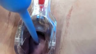 free porn video 22 lesbian nose fetish anal porn | Show with cervix opened with speculum | speculum-4
